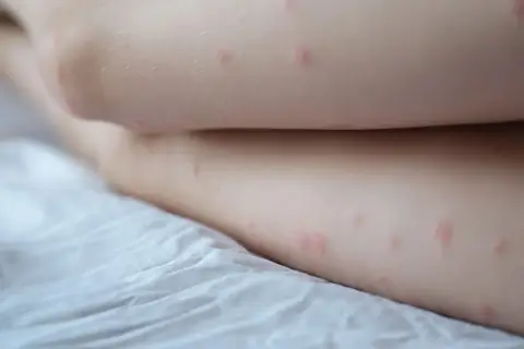 Krostki na pośladkach? To Folliculitis lub KP! Poznaj rozwiązania