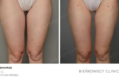 Liposukcja: modelowanie sylwetki czy odchudzanie? Sprawdź, co musisz wiedzieć