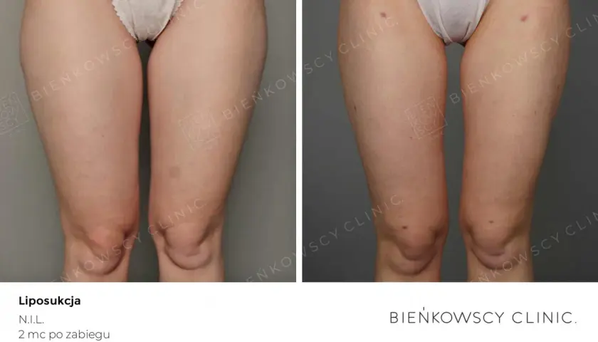 Liposukcja: modelowanie sylwetki czy odchudzanie? Sprawdź, co musisz wiedzieć
