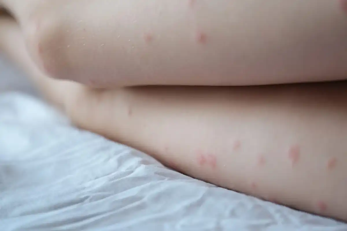 Krostki na pośladkach? To Folliculitis lub KP! Poznaj rozwiązania